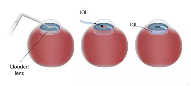 Ocumetics6